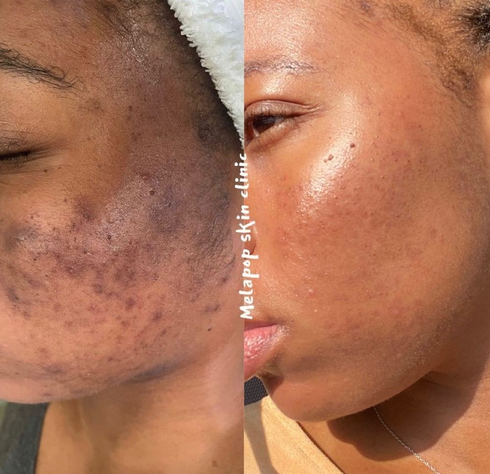 Melapop skin clinic hyperpigmentation before and after