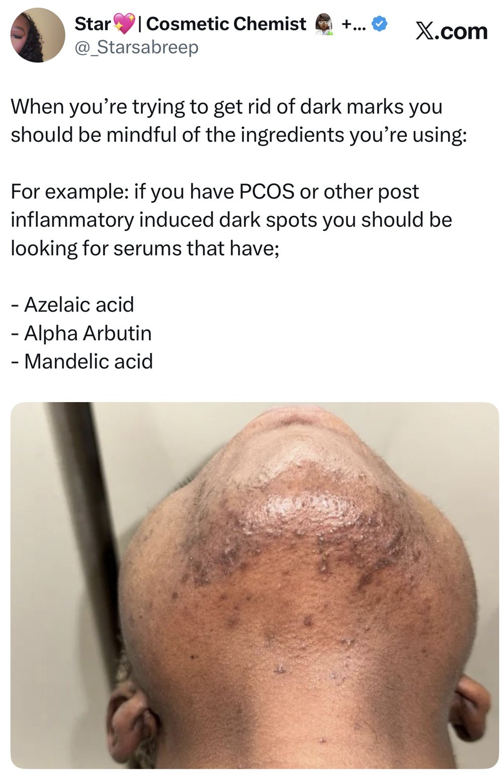 Founder post on treating post inflammatory dark marks