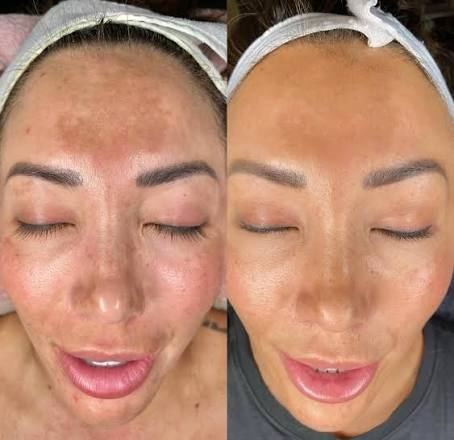 Melasma before and after