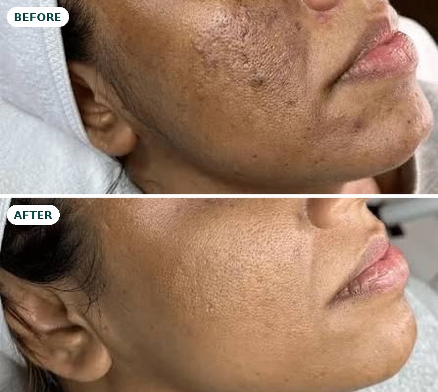 Hyperpigmentation before and after